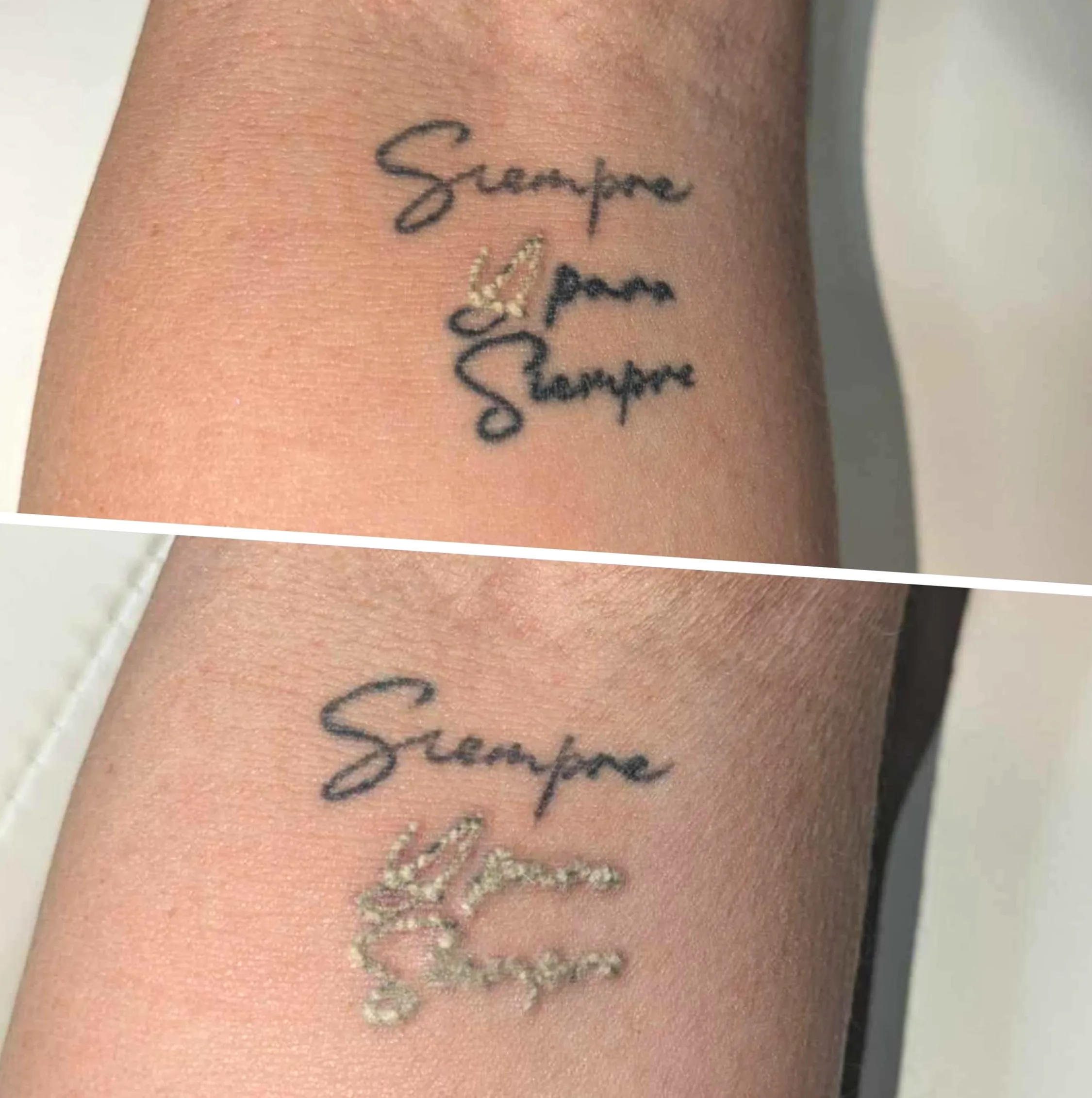 safe tattoo removal for sensitive skin