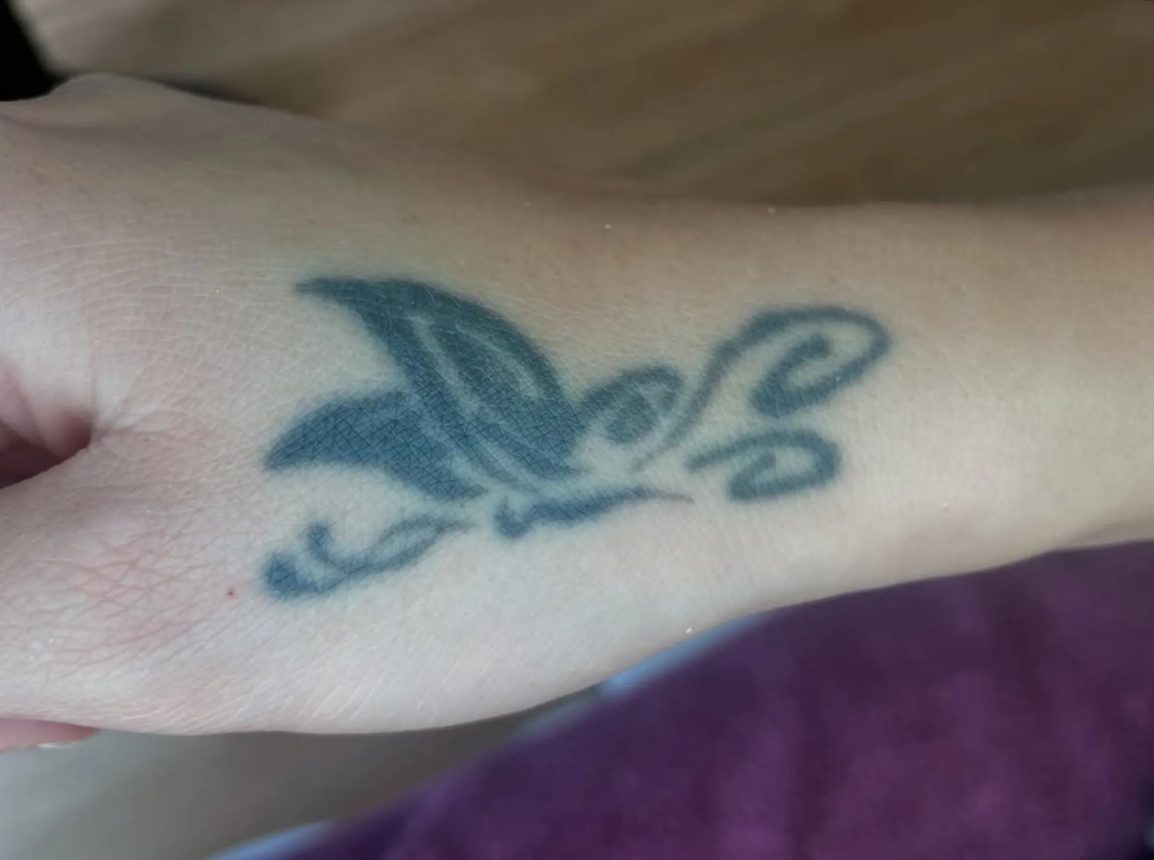 risks of tattoo removal by skin type