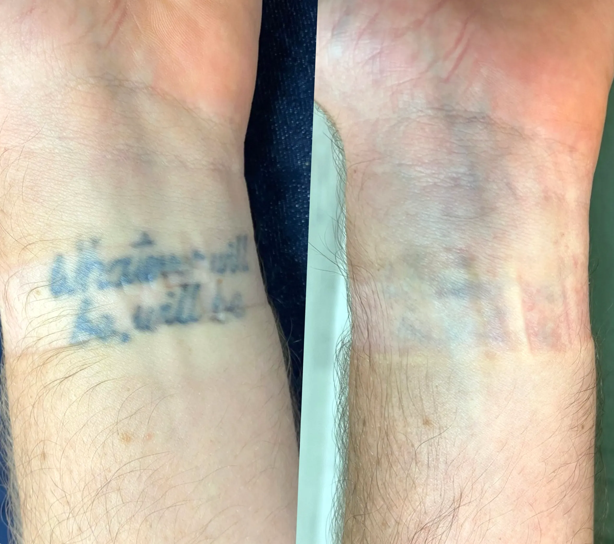 Fitzpatrick scale tattoo removal