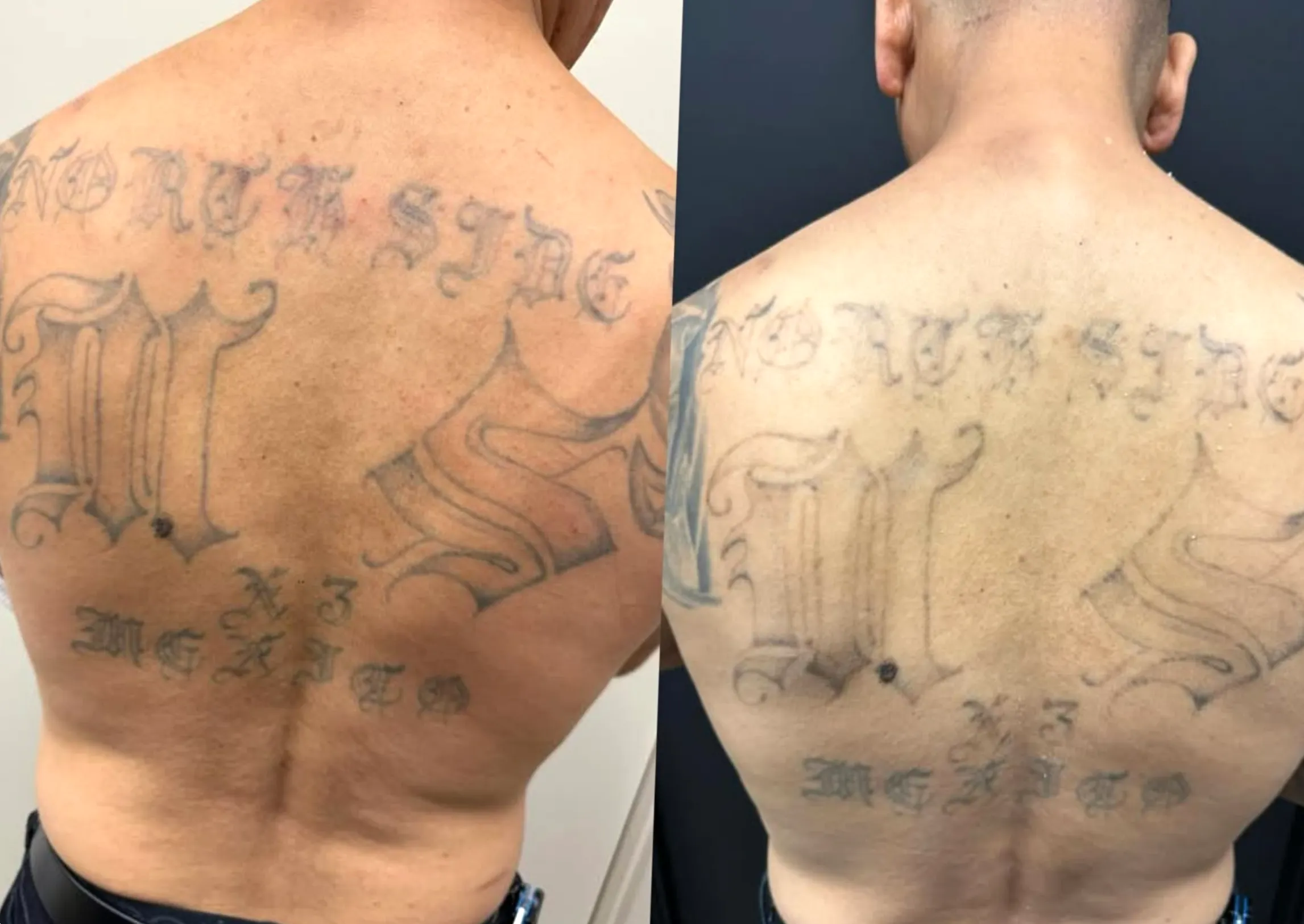tattoo removal for dark skin