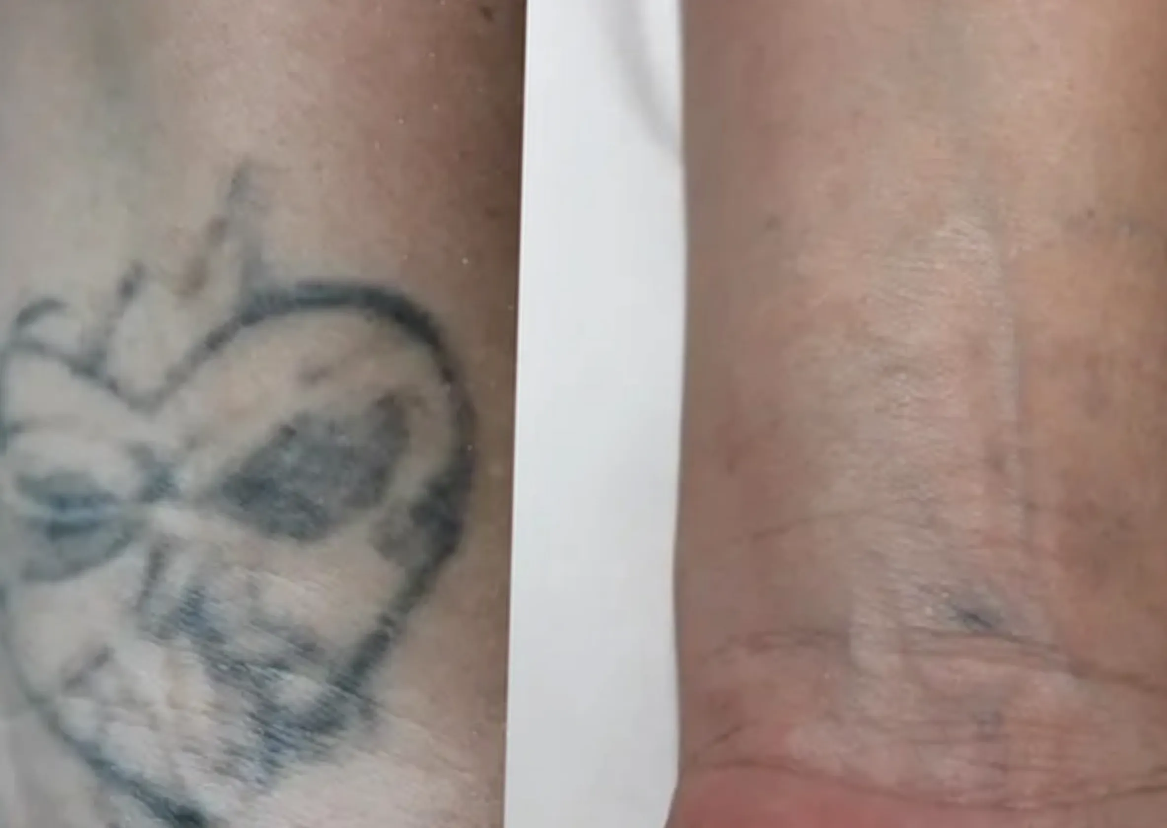 laser tattoo removal Melbourne