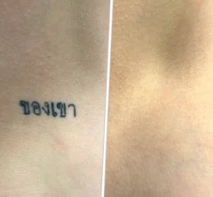 what skin tone is best for tattoo removal